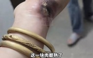 一瞬间手被烧熟,金手镯被电碎!女子给电动车充电,不慎碰到充电口受伤